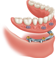 Bar Attached Denture Diagram