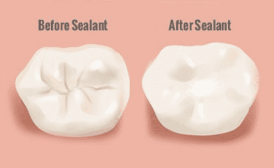 Dental Sealant Before and After Diagram