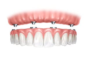 Implant Retained Upper Denture Diagram
