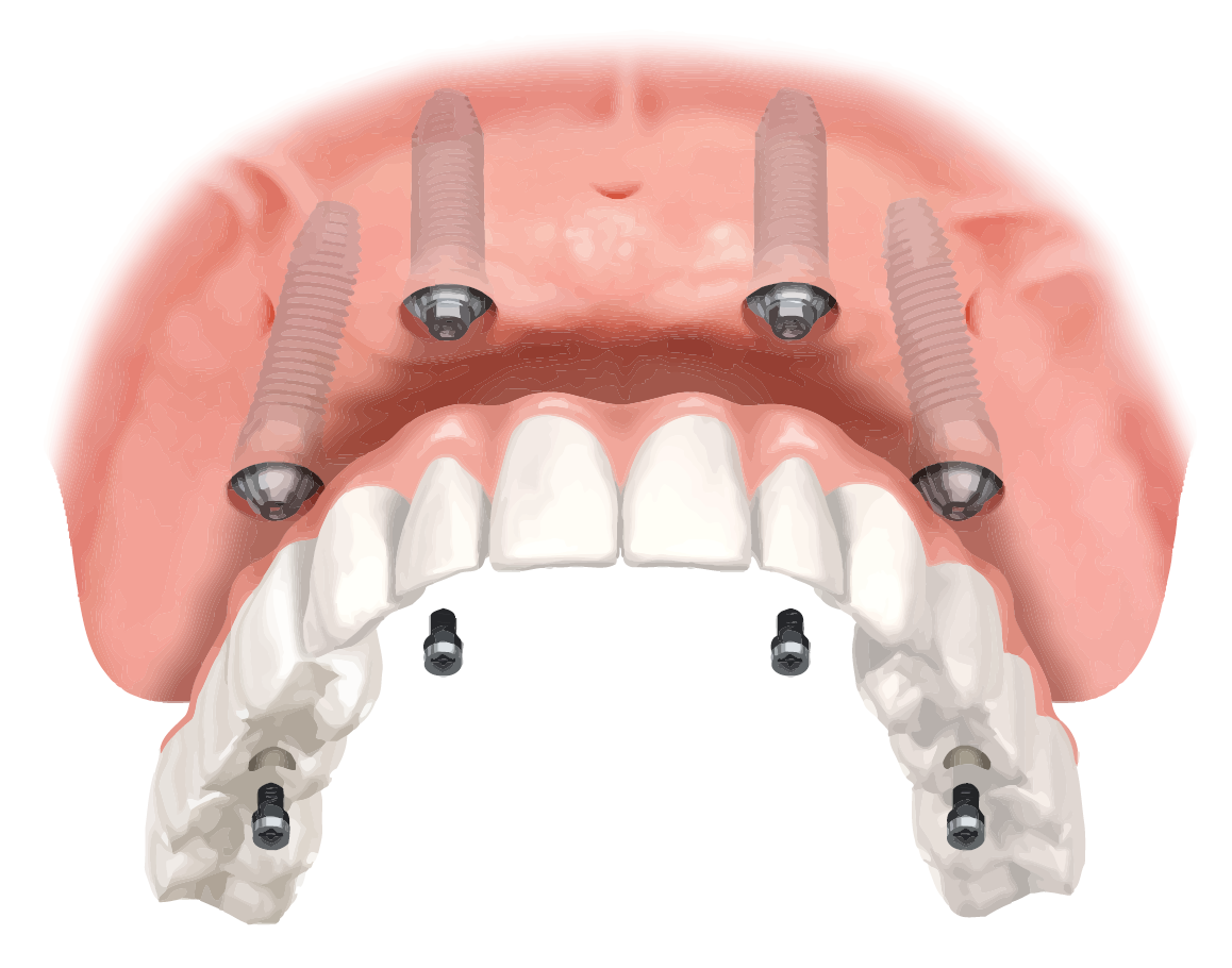 Screw Retained Denture Diagram